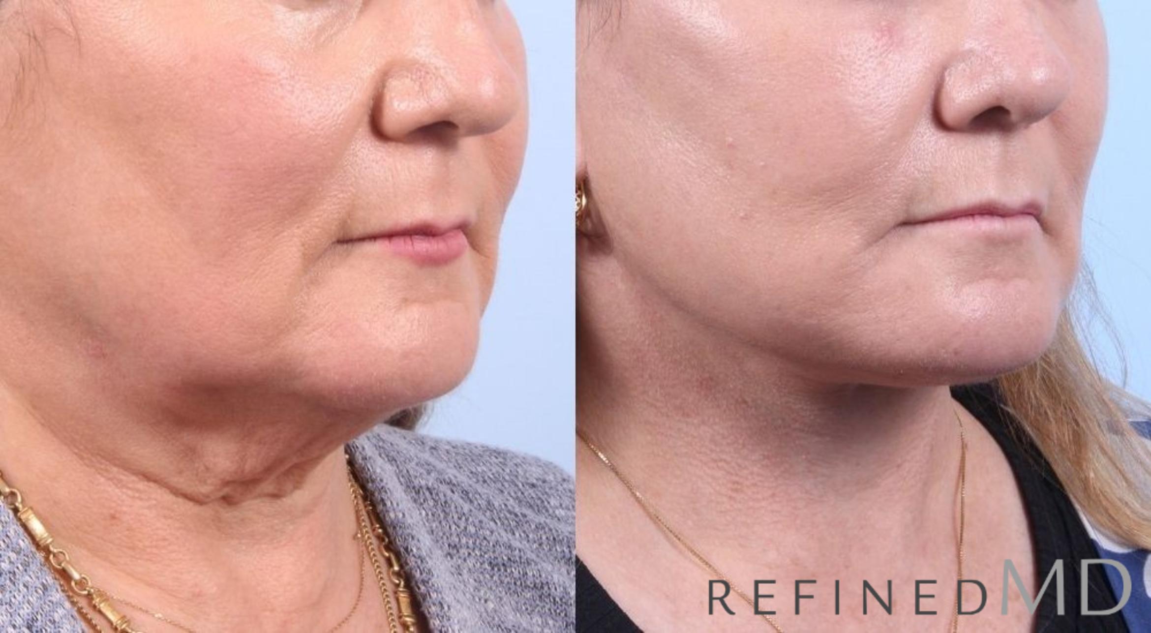 Before & After Facelift Case 1081 View 2 View in Los Gatos & San Jose, CA