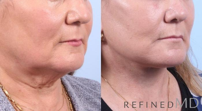 Before & After Facelift Case 1081 View 2 View in Los Gatos & San Jose, CA