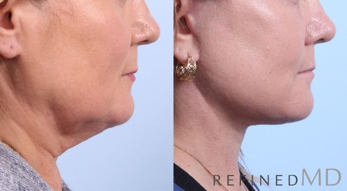 Before & After Facelift Case 1081 View 3 View in Los Gatos & San Jose, CA
