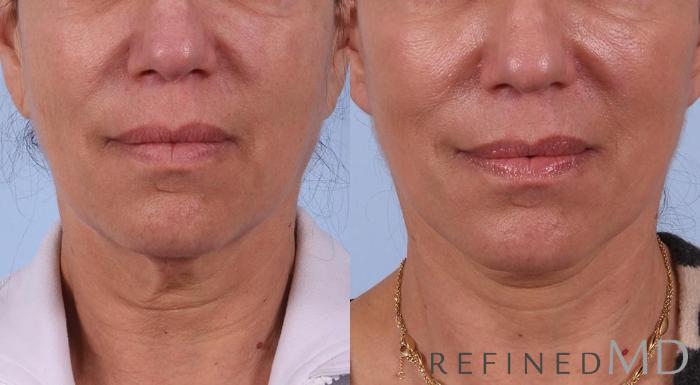 Before & After Facelift Case 1082 View 1 View in Los Gatos & San Jose, CA