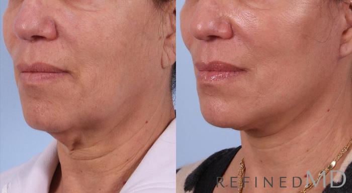 Before & After Facelift Case 1082 View 2 View in Los Gatos & San Jose, CA