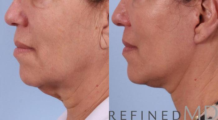 Before & After Facelift Case 1082 View 3 View in Los Gatos & San Jose, CA