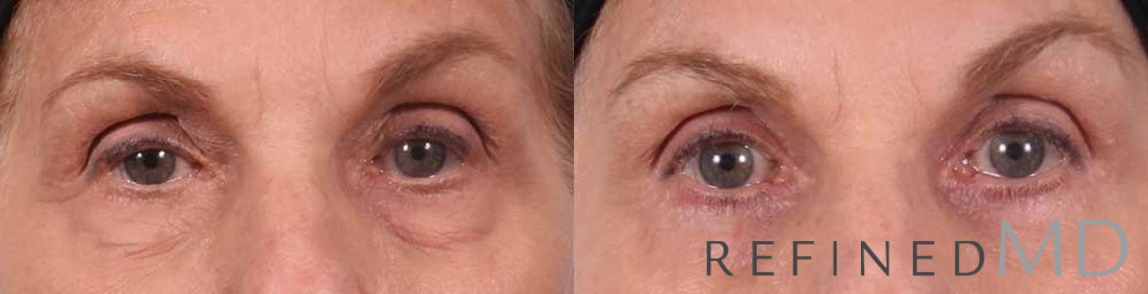 Before & After Lower Eyelid Case 1088 View 1 View in Los Gatos & San Jose, CA