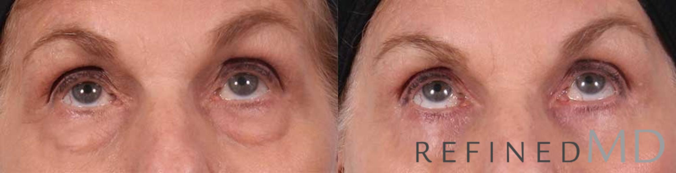 Before & After Lower Eyelid Case 1088 View 2 View in Los Gatos & San Jose, CA