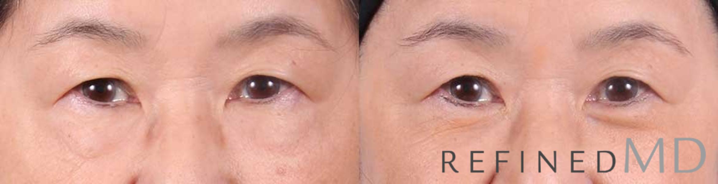Before & After Lower Eyelid Case 1089 View 1 View in Los Gatos & San Jose, CA