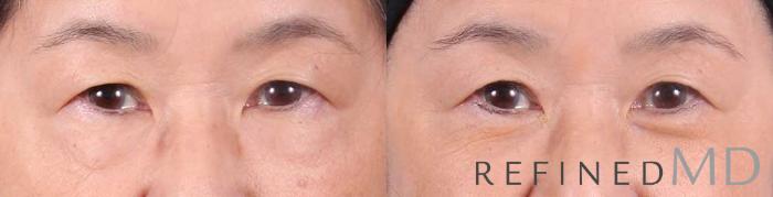 Before & After Lower Eyelid Case 1089 View 1 View in Los Gatos & San Jose, CA