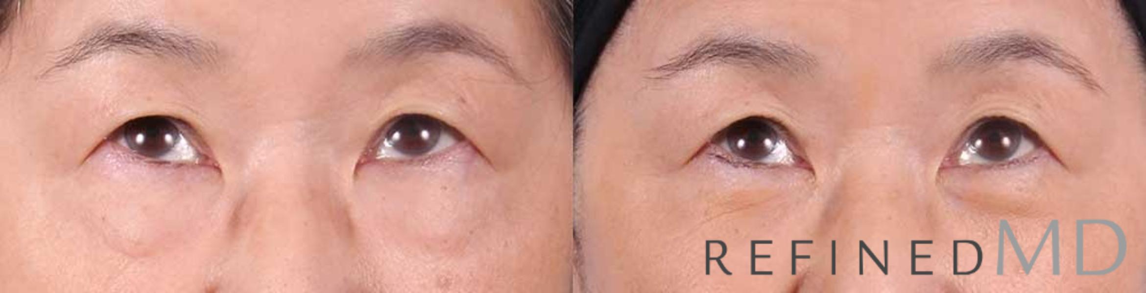 Before & After Lower Eyelid Case 1089 View 2 View in Los Gatos & San Jose, CA