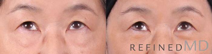 Before & After Lower Eyelid Case 1089 View 2 View in Los Gatos & San Jose, CA