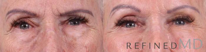 Before & After Lower Eyelid Case 1090 View 1 View in Los Gatos & San Jose, CA