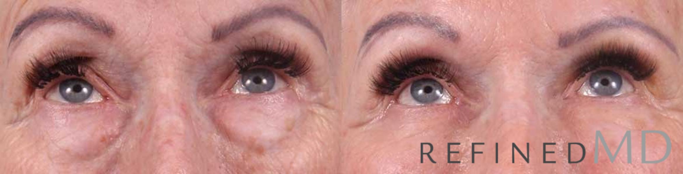 Before & After Lower Eyelid Case 1090 View 2 View in Los Gatos & San Jose, CA