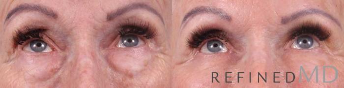 Before & After Lower Eyelid Case 1090 View 2 View in Los Gatos & San Jose, CA