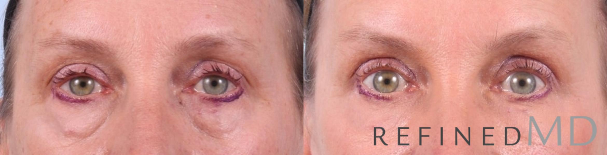Before & After Lower Eyelid Case 1091 View 1 View in Los Gatos & San Jose, CA