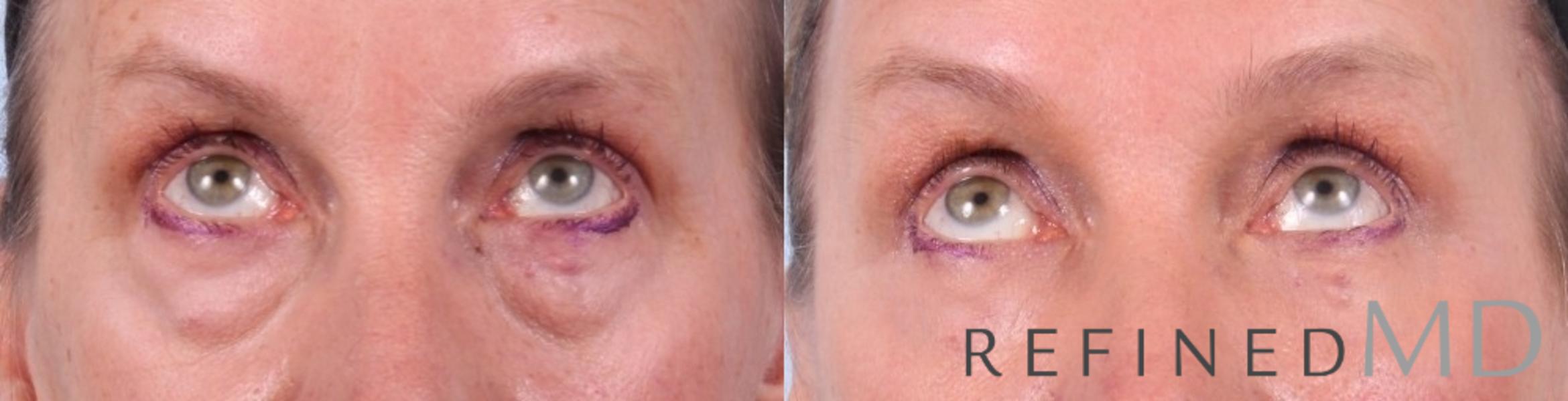 Before & After Lower Eyelid Case 1091 View 2 View in Los Gatos & San Jose, CA
