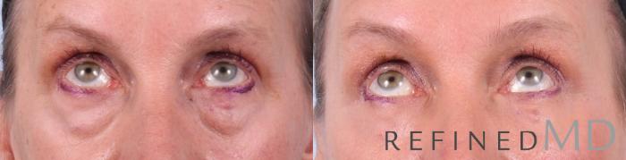 Before & After Lower Eyelid Case 1091 View 2 View in Los Gatos & San Jose, CA