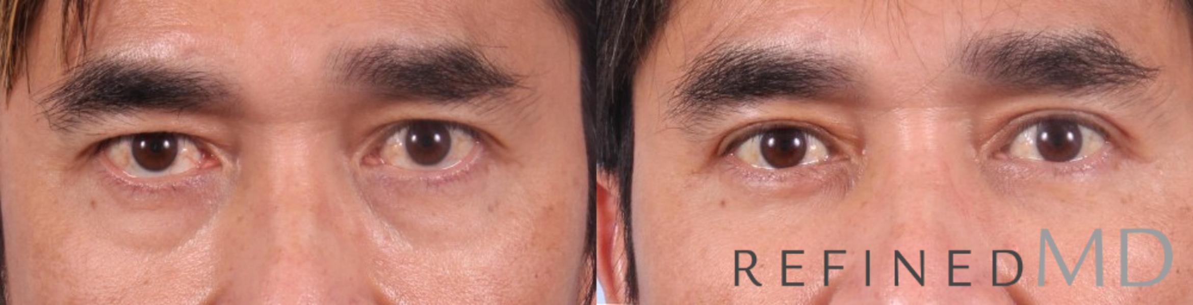 Before & After Lower Eyelid Case 1092 View 1 View in Los Gatos & San Jose, CA