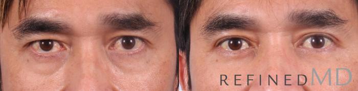 Before & After Lower Eyelid Case 1092 View 1 View in Los Gatos & San Jose, CA