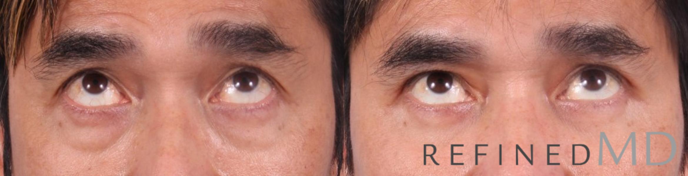 Before & After Lower Eyelid Case 1092 View 2 View in Los Gatos & San Jose, CA