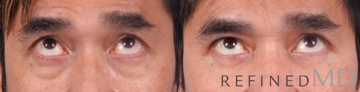 Before & After Lower Eyelid Case 1092 View 2 View in Los Gatos & San Jose, CA
