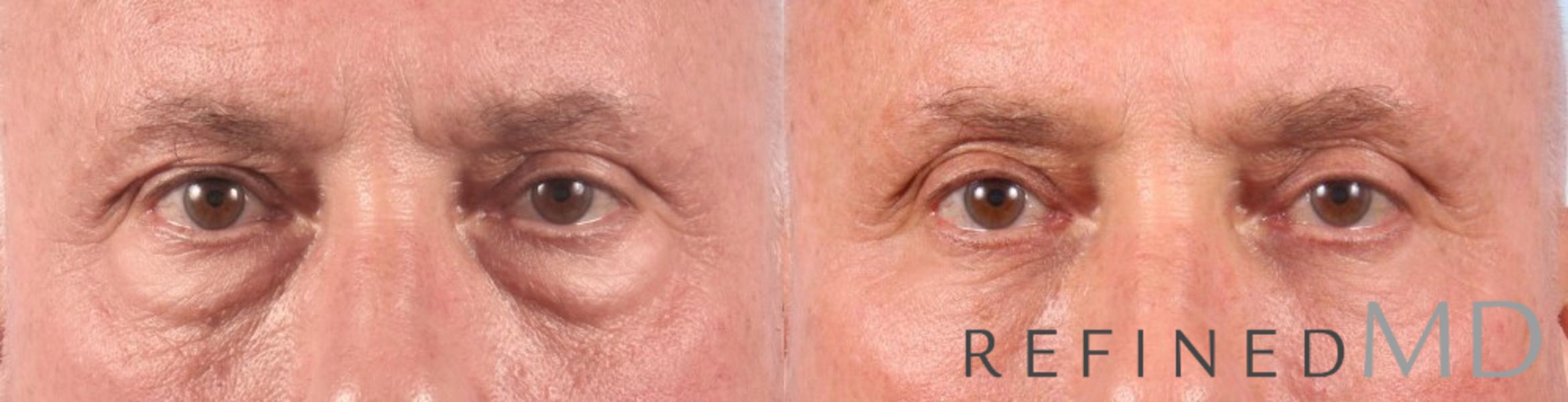 Before & After Lower Eyelid Case 1093 View 1 View in Los Gatos & San Jose, CA