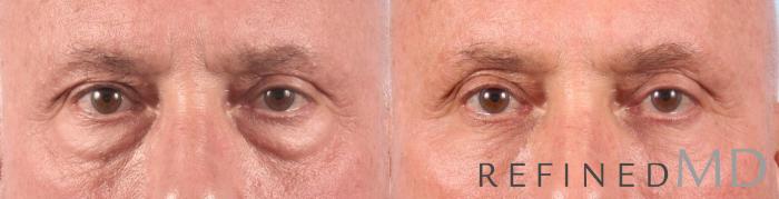 Before & After Lower Eyelid Case 1093 View 1 View in Los Gatos & San Jose, CA