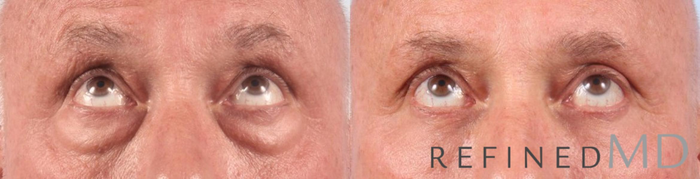 Before & After Lower Eyelid Case 1093 View 2 View in Los Gatos & San Jose, CA