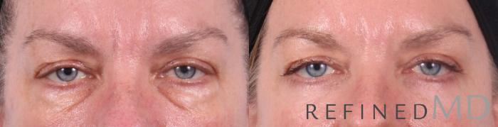 Before & After Lower Eyelid Case 1094 View 1 View in Los Gatos & San Jose, CA