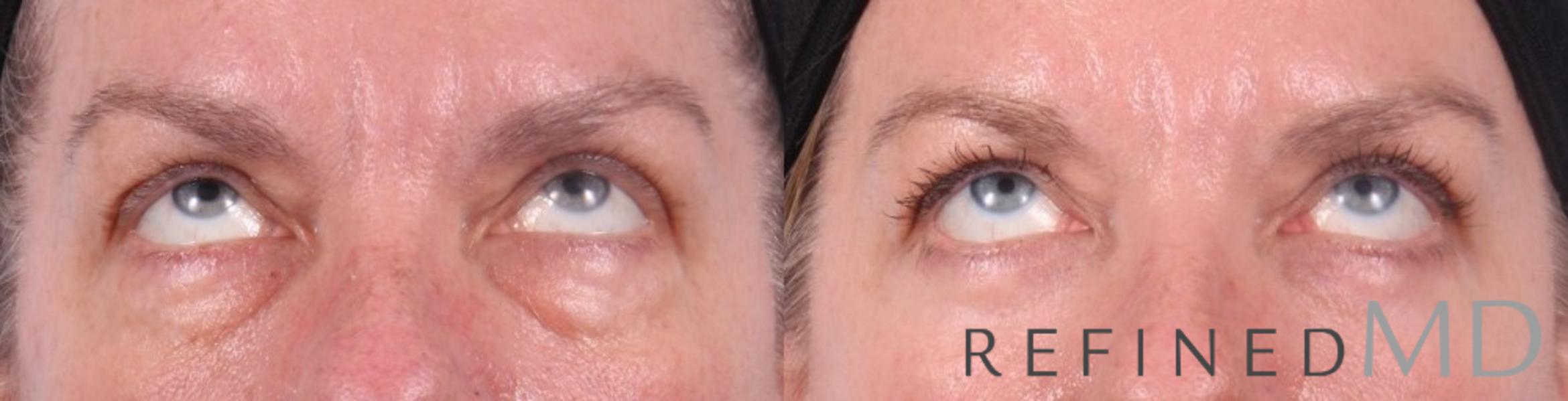 Before & After Lower Eyelid Case 1094 View 2 View in Los Gatos & San Jose, CA