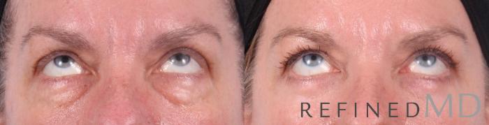 Before & After Lower Eyelid Case 1094 View 2 View in Los Gatos & San Jose, CA