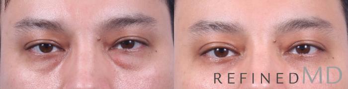 Before & After Lower Eyelid Case 1095 View 1 View in Los Gatos & San Jose, CA