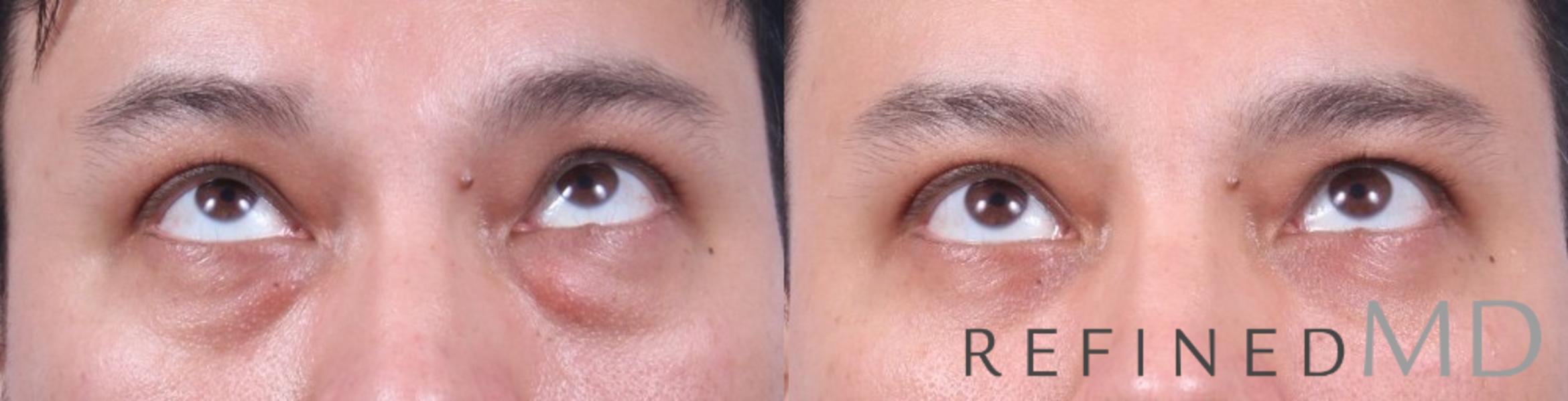 Before & After Lower Eyelid Case 1095 View 2 View in Los Gatos & San Jose, CA