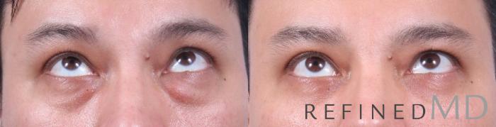 Before & After Lower Eyelid Case 1095 View 2 View in Los Gatos & San Jose, CA