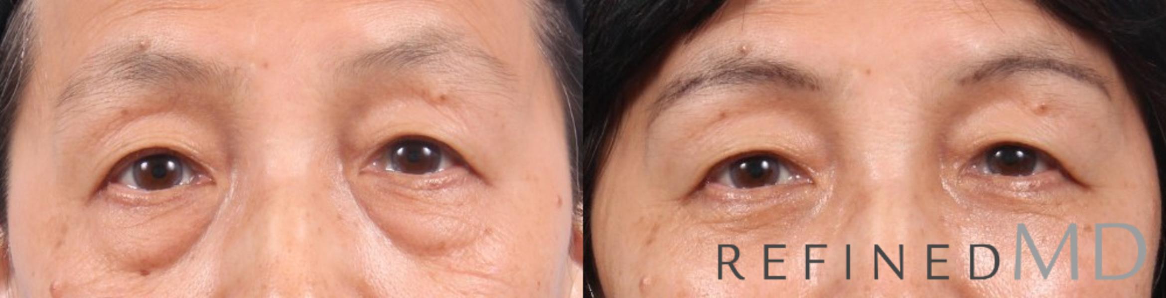 Before & After Lower Eyelid Case 1096 View 1 View in Los Gatos & San Jose, CA