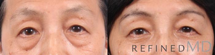 Before & After Lower Eyelid Case 1096 View 1 View in Los Gatos & San Jose, CA