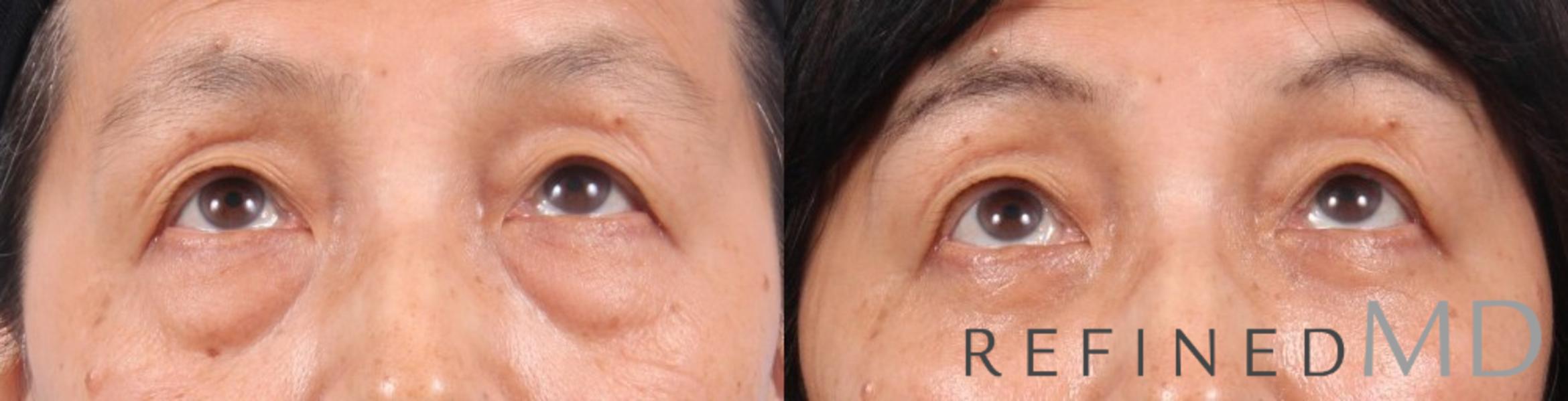 Before & After Lower Eyelid Case 1096 View 2 View in Los Gatos & San Jose, CA
