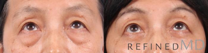 Before & After Lower Eyelid Case 1096 View 2 View in Los Gatos & San Jose, CA