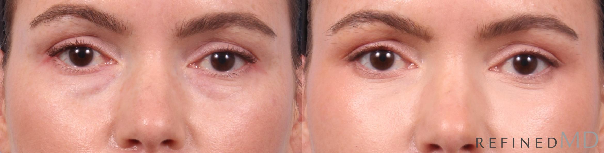 Before & After Lower Eyelid Case 1127 Front View in Los Gatos & San Jose, CA
