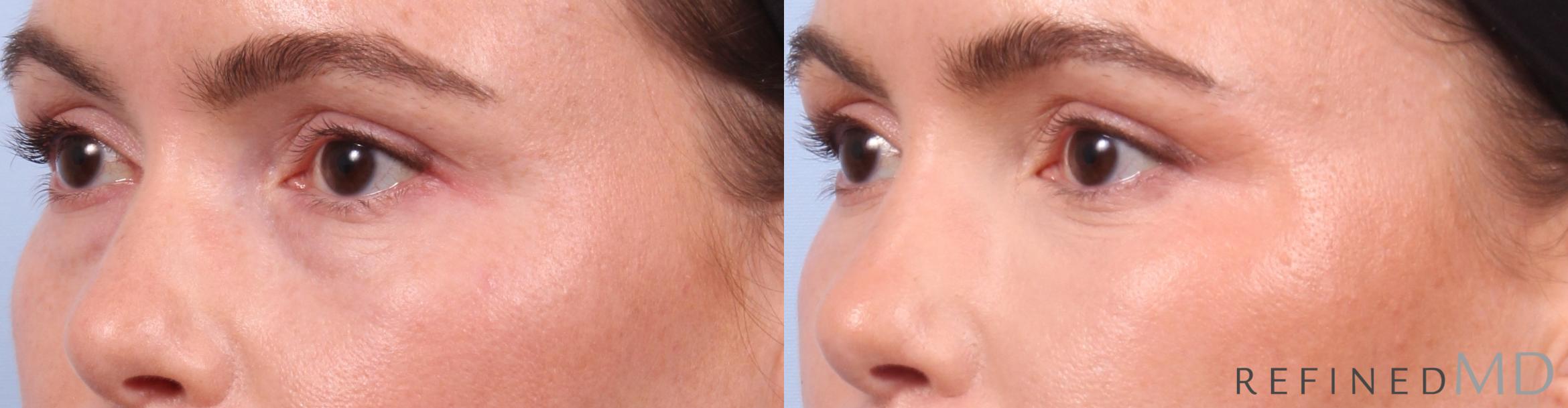 Before & After Lower Eyelid Case 1127 Left Oblique View in Los Gatos & San Jose, CA