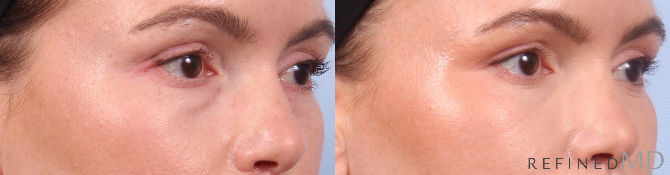Before & After Lower Eyelid Case 1127 Right Oblique View in Los Gatos & San Jose, CA