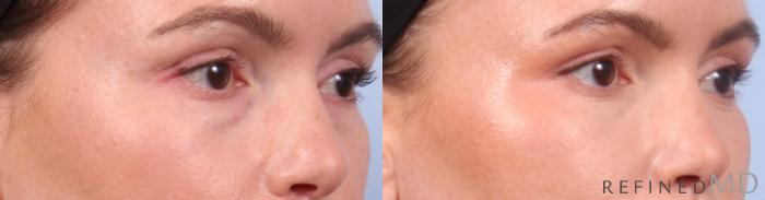 Before & After Lower Eyelid Case 1127 Right Oblique View in Los Gatos & San Jose, CA