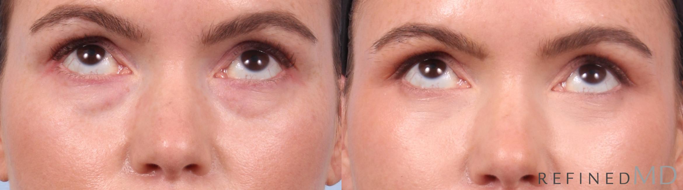Before & After Lower Eyelid Case 1127 Up Gaze View in Los Gatos & San Jose, CA