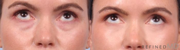 Before & After Lower Eyelid Case 1127 Up Gaze View in Los Gatos & San Jose, CA