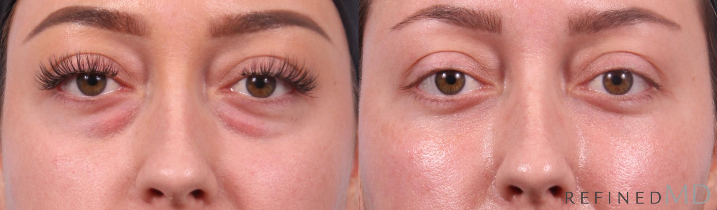 Before & After Lower Eyelid Case 1128 Front View in Los Gatos & San Jose, CA