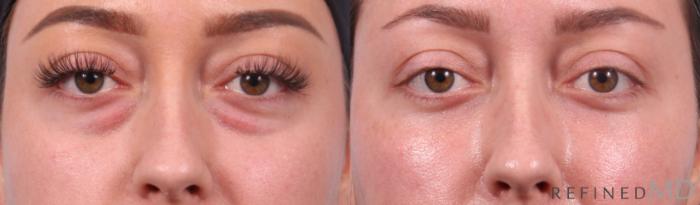 Before & After Lower Eyelid Case 1128 Front View in Los Gatos & San Jose, CA