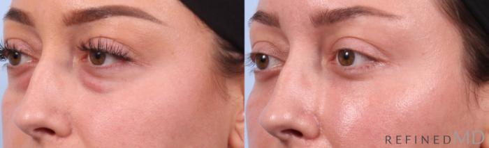 Before & After Lower Eyelid Case 1128 Left Oblique View in Los Gatos & San Jose, CA