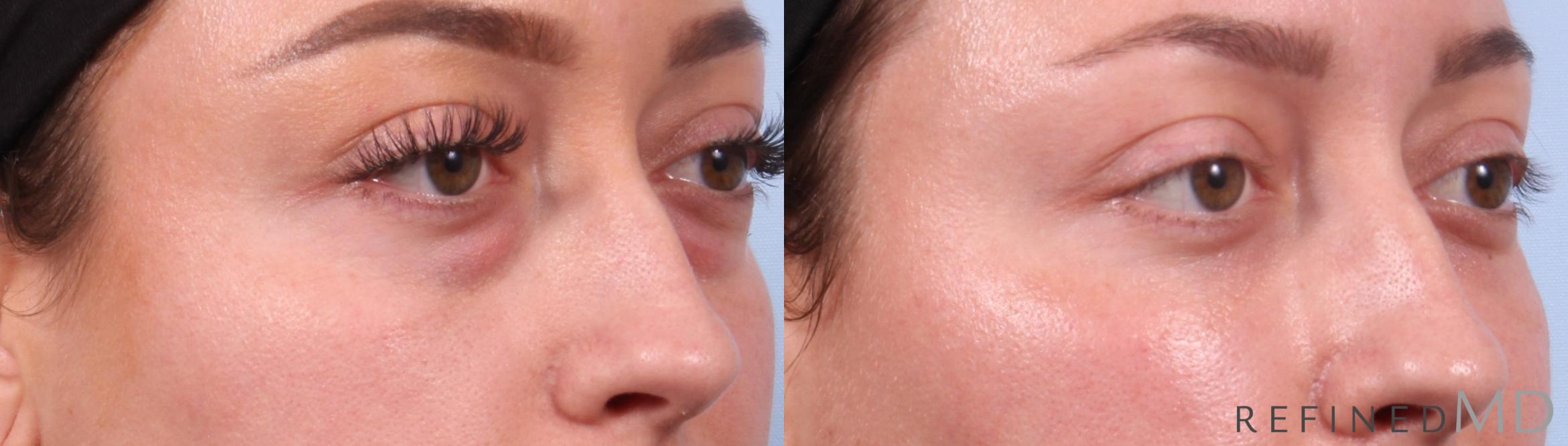 Before & After Lower Eyelid Case 1128 Right Oblique View in Los Gatos & San Jose, CA