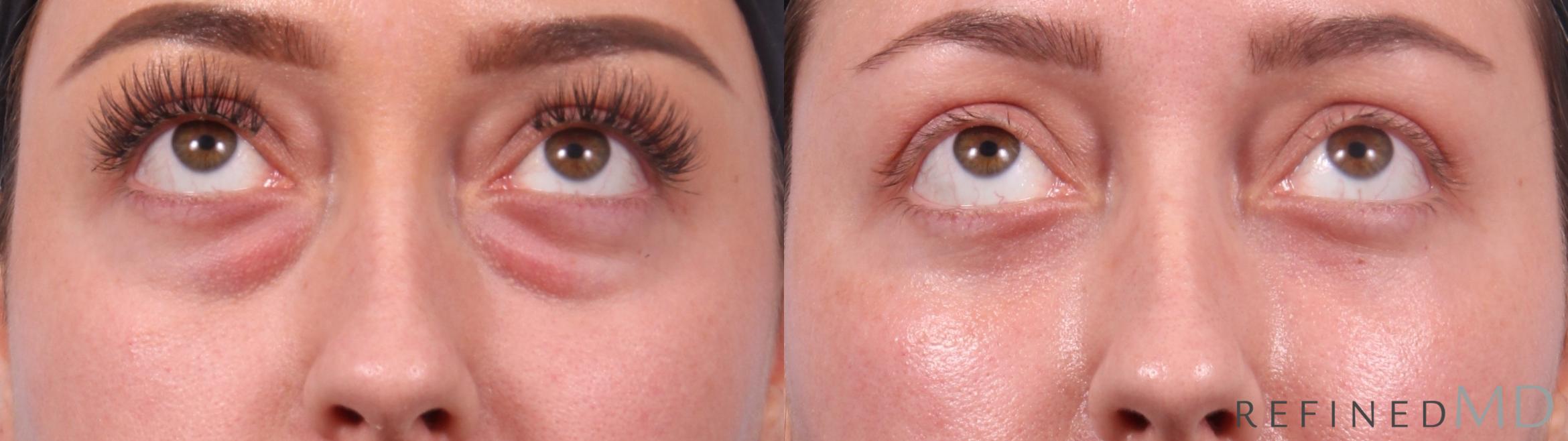 Before & After Lower Eyelid Case 1128 Up Gaze View in Los Gatos & San Jose, CA