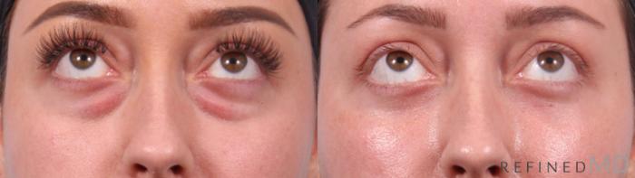 Before & After Lower Eyelid Case 1128 Up Gaze View in Los Gatos & San Jose, CA