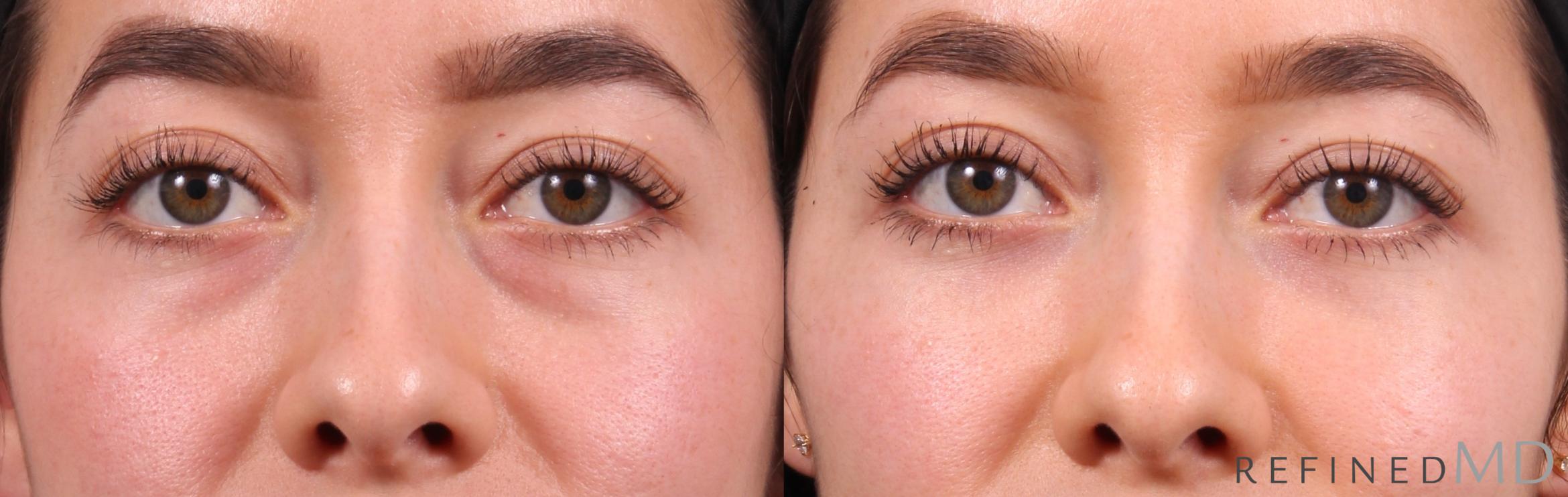 Before & After Lower Eyelid Case 1129 Front View in Los Gatos & San Jose, CA