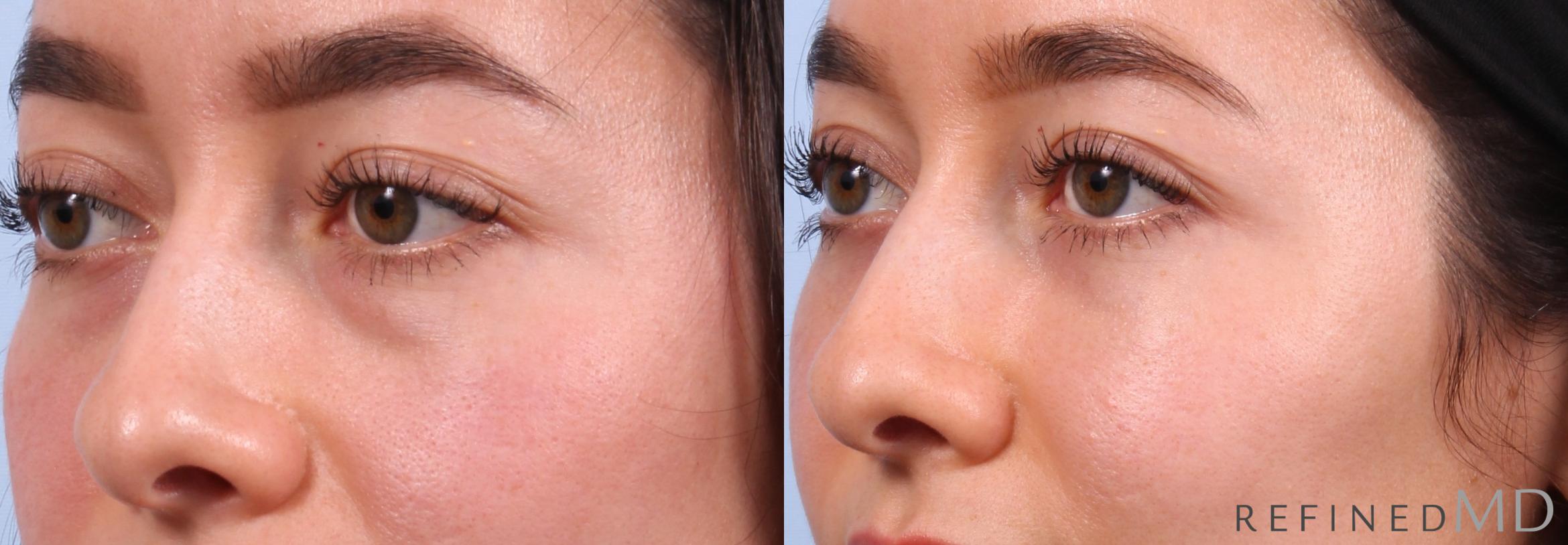 Before & After Lower Eyelid Case 1129 Left Oblique View in Los Gatos & San Jose, CA