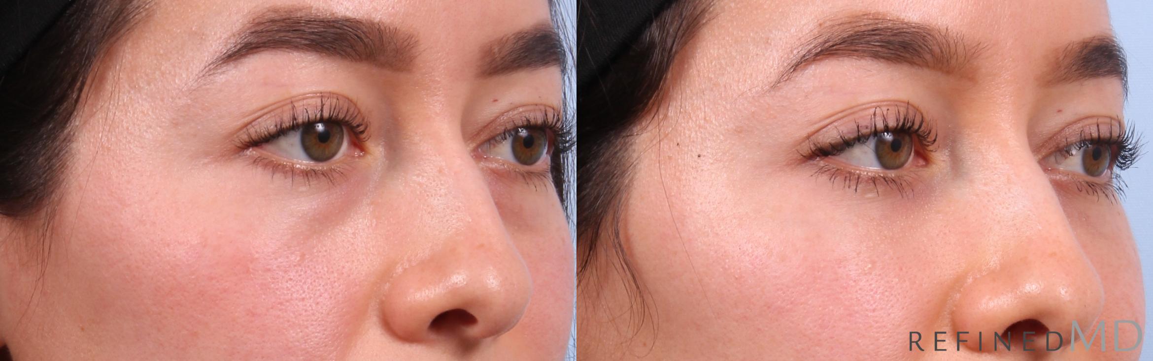 Before & After Lower Eyelid Case 1129 Right Oblique View in Los Gatos & San Jose, CA